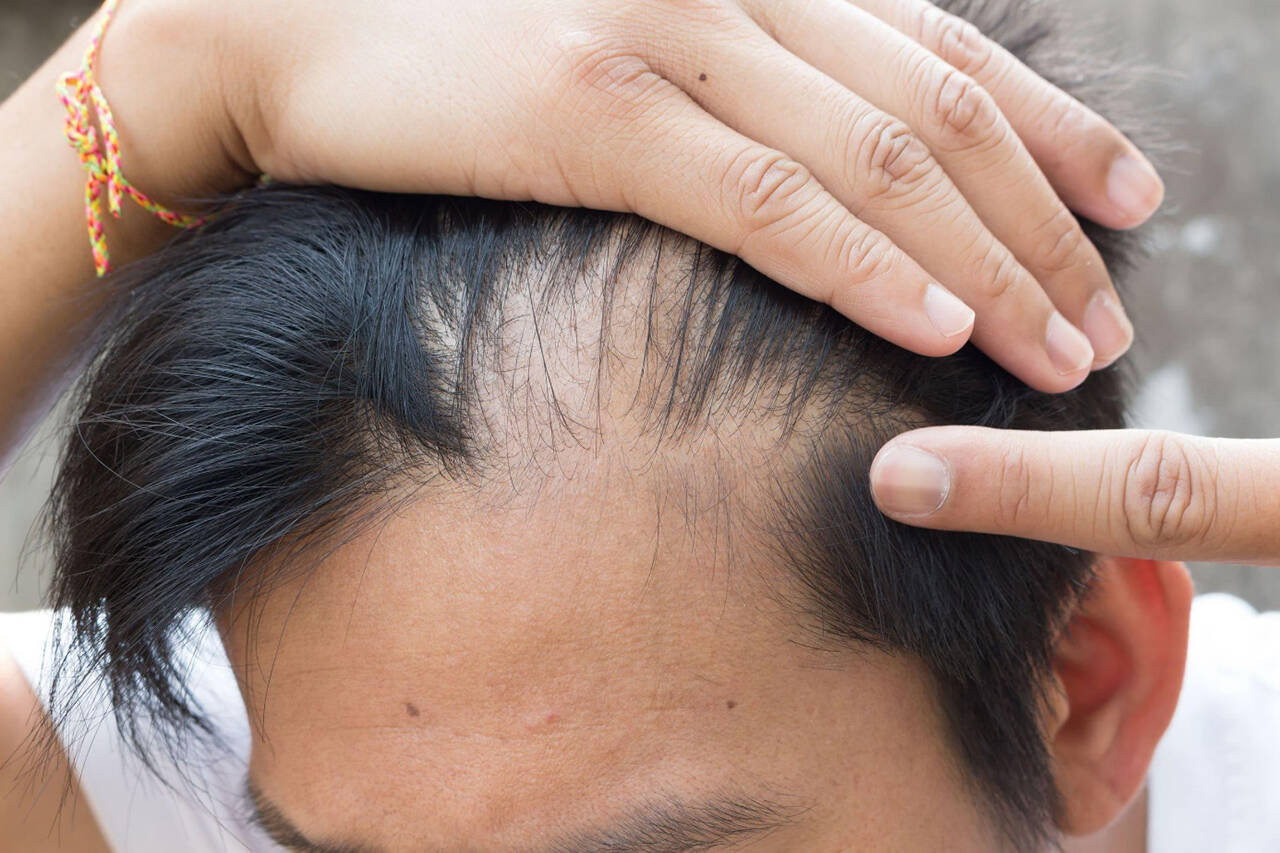 RU58841 Before & After Realistic Hair Growth Results 2023